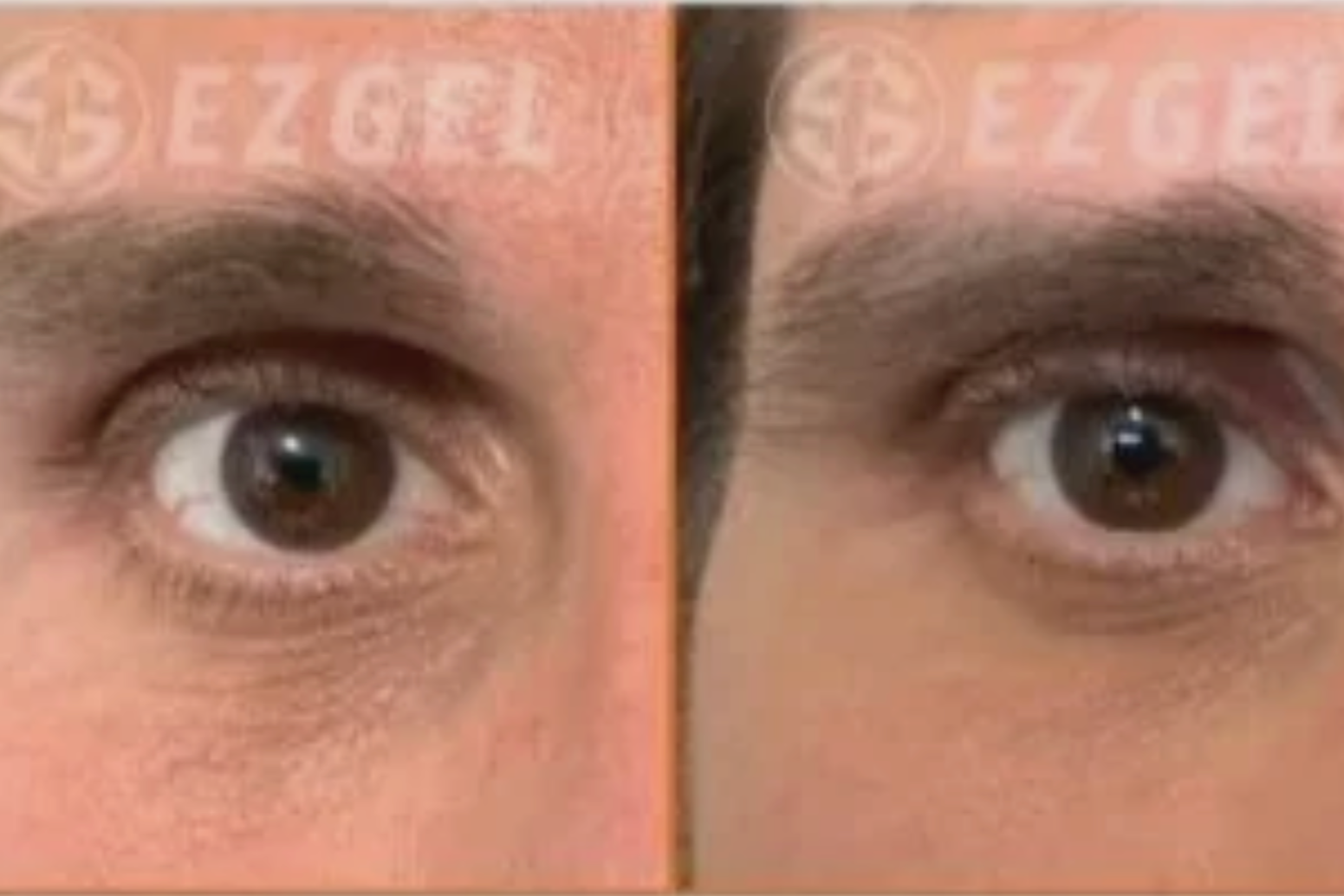 EZ Gel vs. Filler: Compare and Contrast