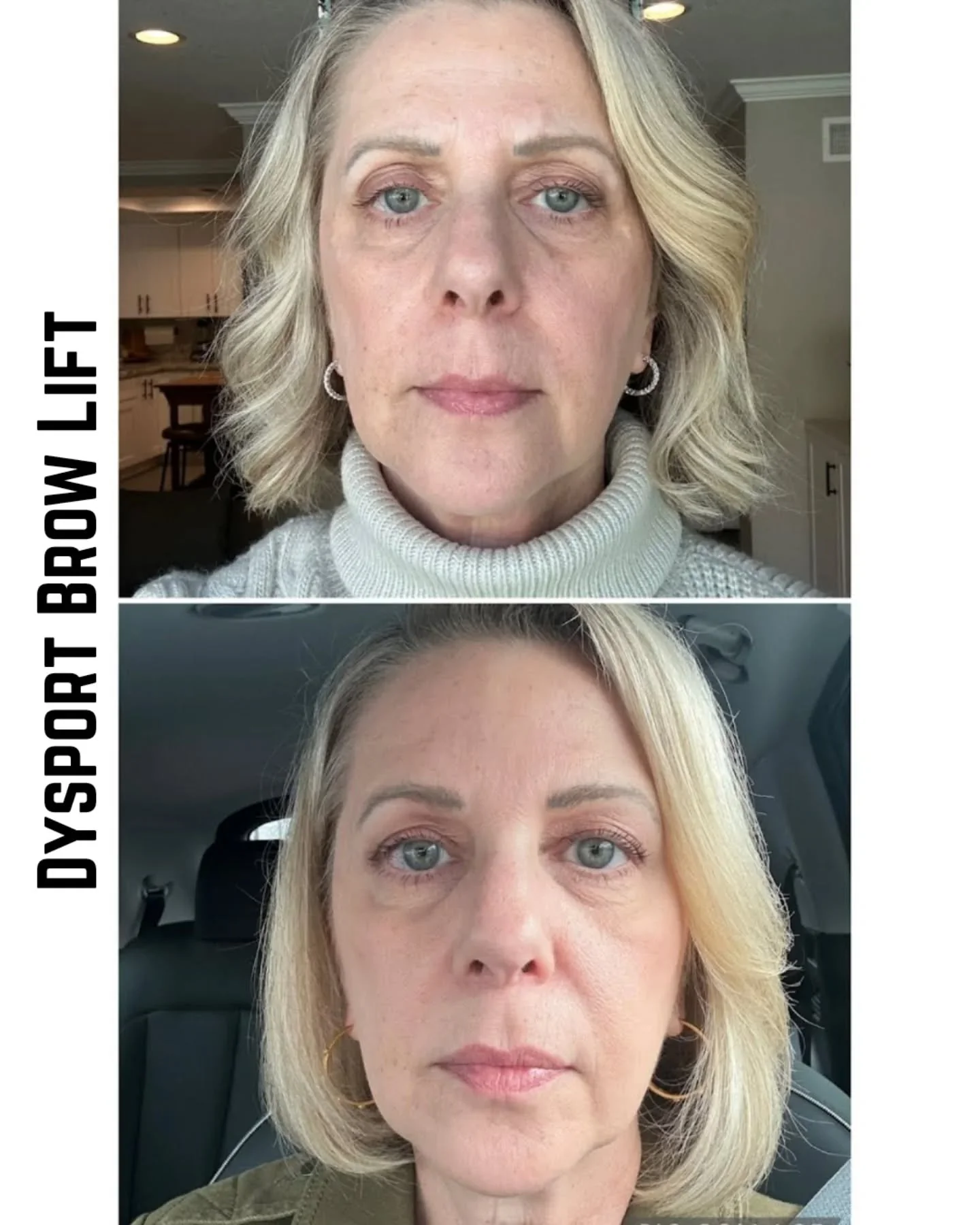 ☀️Subtle and powerful, this is a prime example of a brow lift with Dysport. How does this work? By relaxing (aka treating with Dysport) all of the muscles that can pull down on the eyebrows, without touching the forehead. The untreated forehead muscl