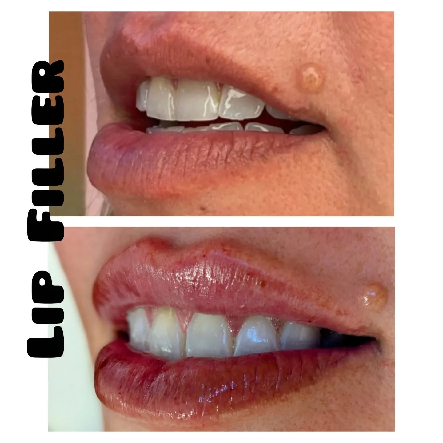 ☀️Before and immediately after some sweet 1st time lip filler🩷 Hydrated and balanced with #versalips 

Nerve block for comfort, and we don't charge extra for that because your injector is a CRNA 🦄

I got very lucky and did not make a single bruise 