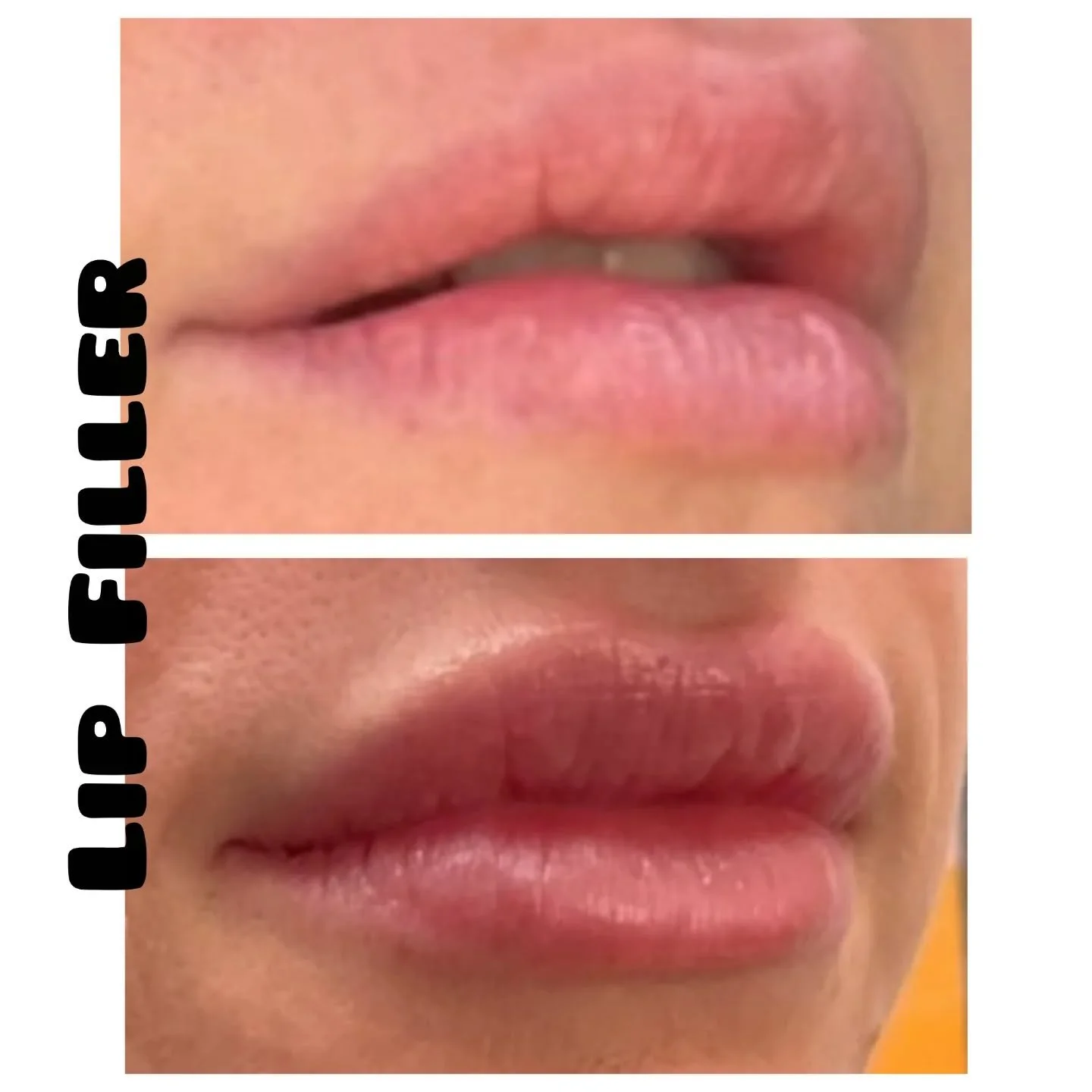 ☀️Before &amp; 2 wk After Restylane Kysse, first time. ☀️ These lips had great shape to begin with, I just gently volumized them. If you've talked lip filler with me, then you've heard me say: I can't change your lip shape, I can only volumize the li