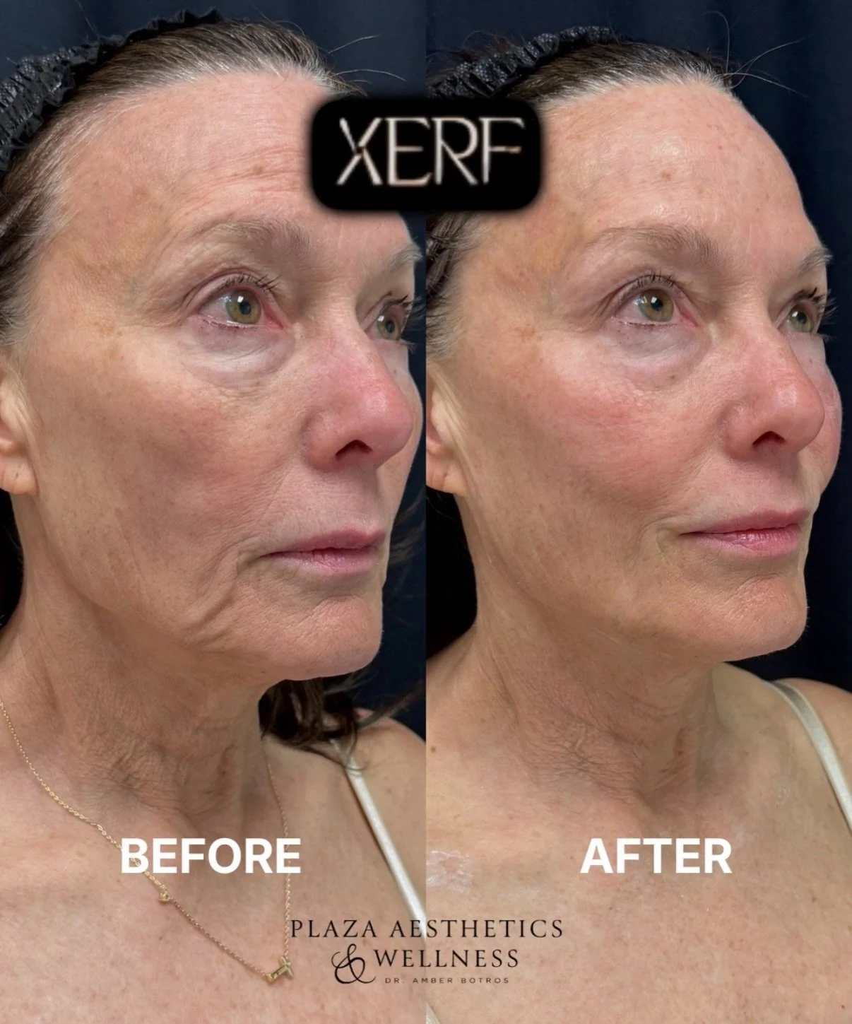 BIG NEWS: XERF is coming to River Sirens Collective.

We&rsquo;re officially opening our XERF waitlist.

XERF is a non-invasive structural skin tightening treatment designed to firm and tighten areas like the:

&bull; Face + jawline
&bull; Jowls
&bul