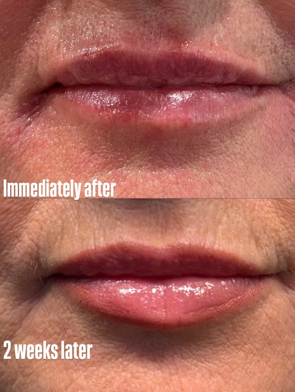 Subtle plump! Still you, just a refresh 💋. 

1/4 syringe and 30 units for only $400 now through end of September!