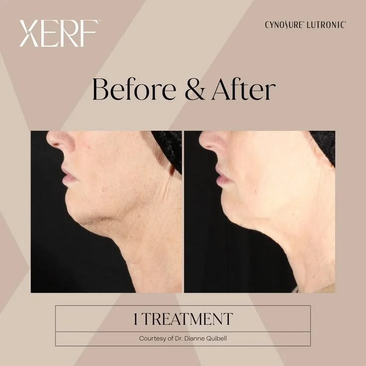 A noninvasive radiofrequency treatment designed to improve the appearance of skin firmness and support collagen remodeling, without the need for surgery.