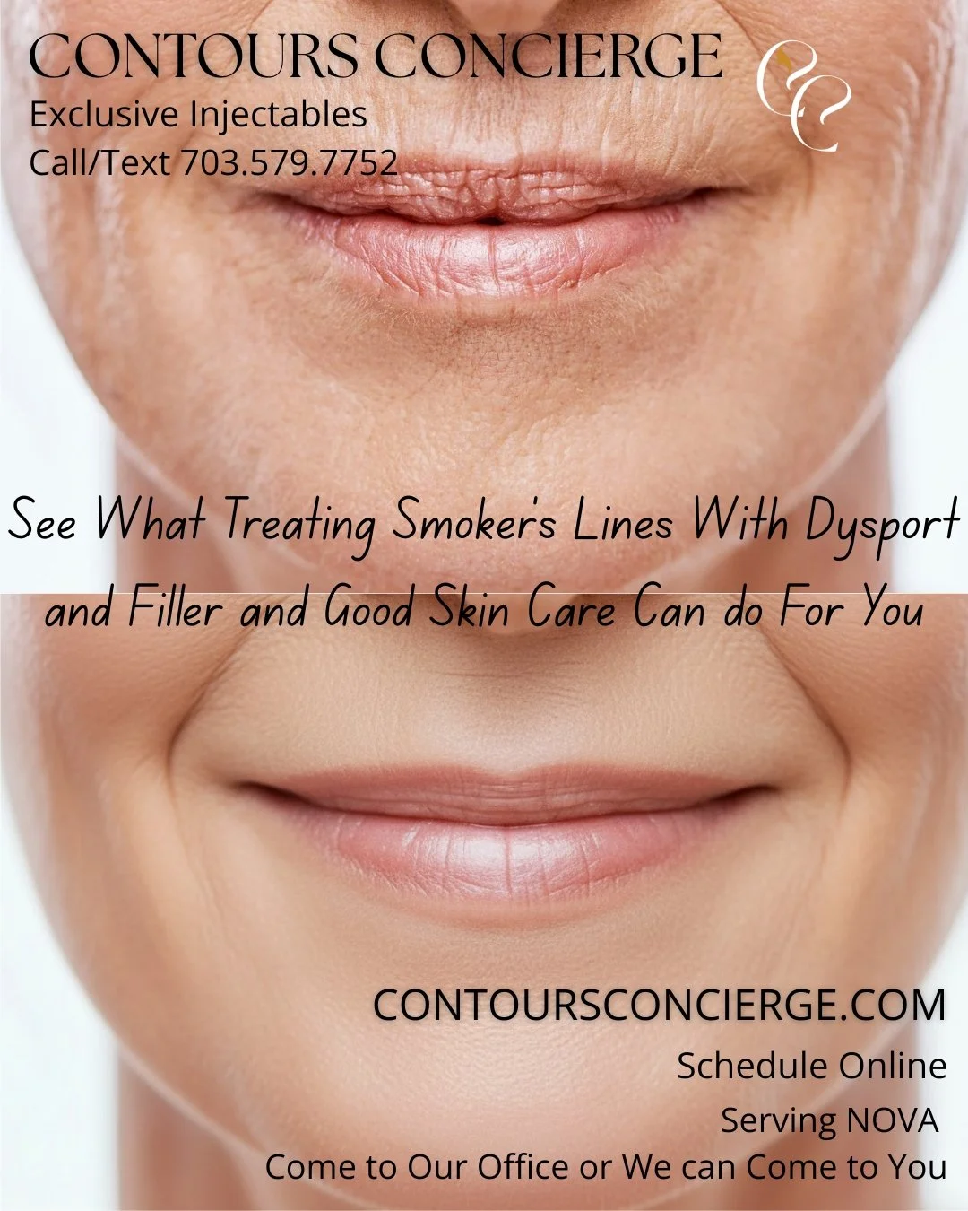 A constant face motion, like smoking or using a straw, can create lip lines. Here, with the use of Dysport (tox) and filler, these lines can be smoothed. Tiny doses of Dysport around the upper lip soften vertical wrinkling and help lipstick stop blee