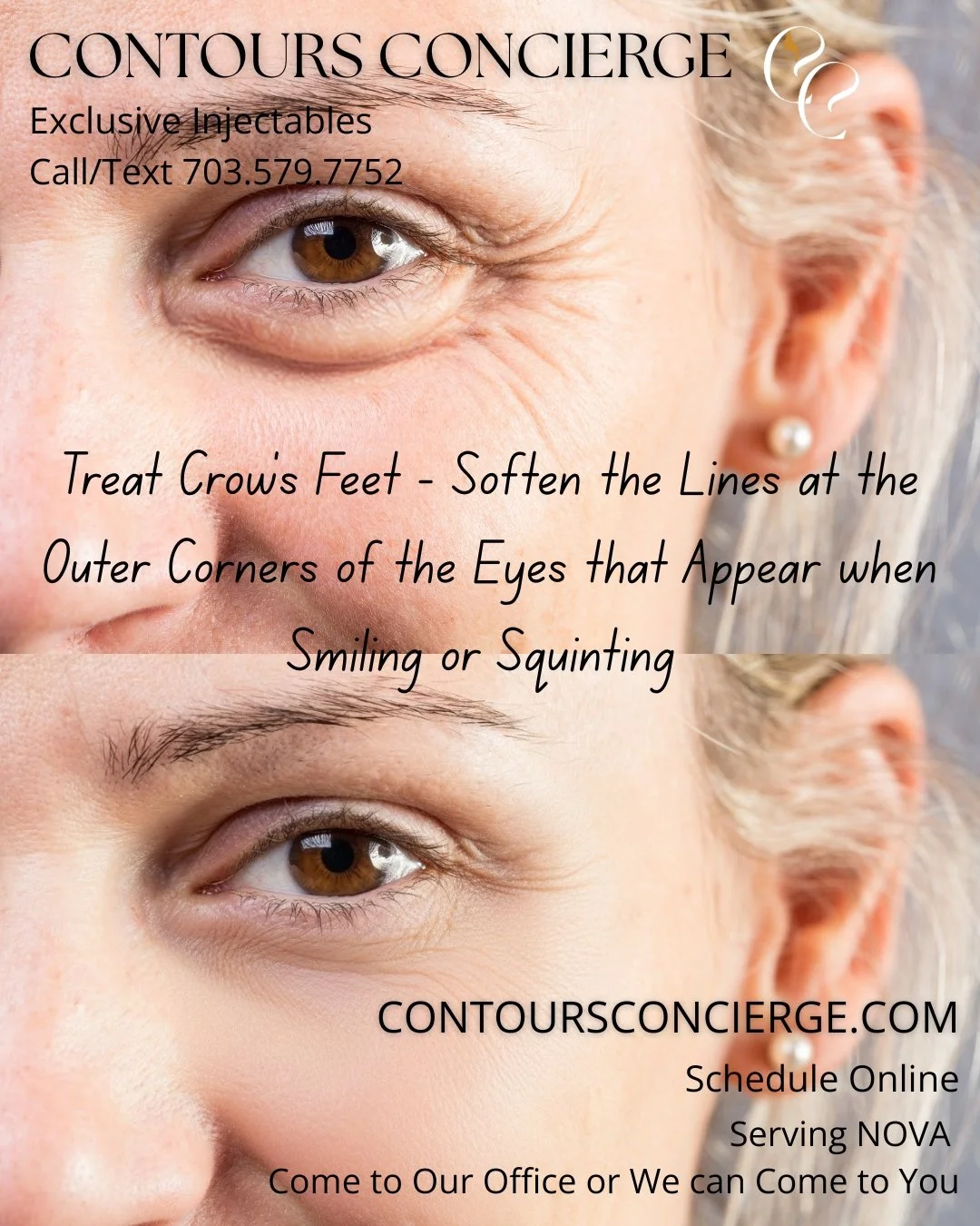 Continuing with what tox can do for you. Crow's feet softening is another popular use of tox. Dysport is wonderful for this given it's widespread after injection. Remember, you choose the environment - we'll come to your home, or you can come to our 