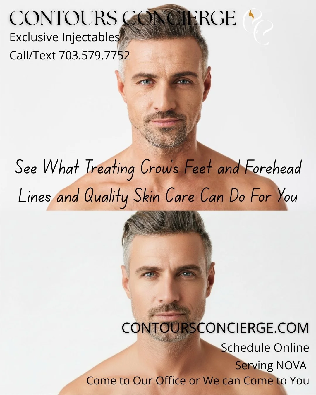 Continuing with tox and adding on great skin care. This gentleman didn't want to get rid of every line he earned. Just soften his forehead and crow feet. His skin tone was also uneven. We used Dysport on his forehead and crow's feet and also changed 
