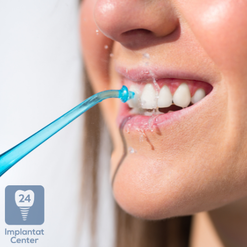 Die Pflege von Zahnimplantaten