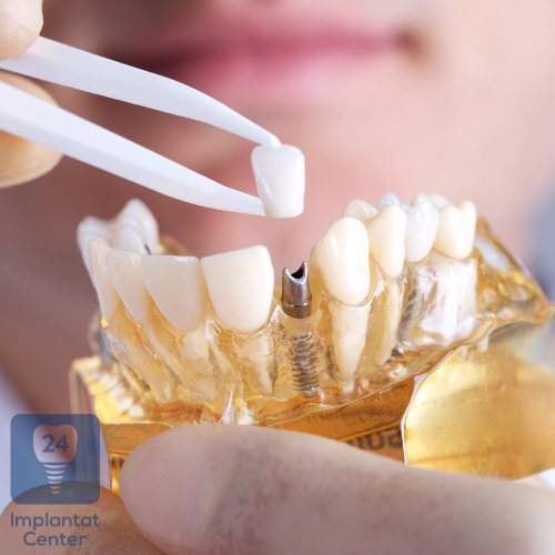 Einführung in die Welt der Zahnimplantate