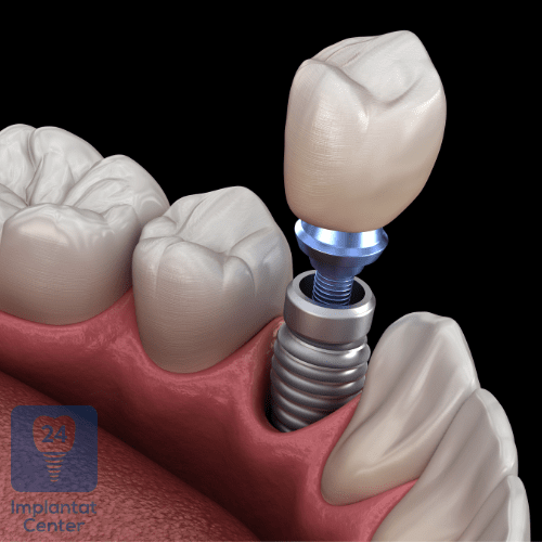 Materialien in der Zahnimplantologie