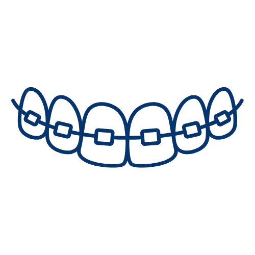 Illustration einer Zahnspange mit Brackets und Drähten.