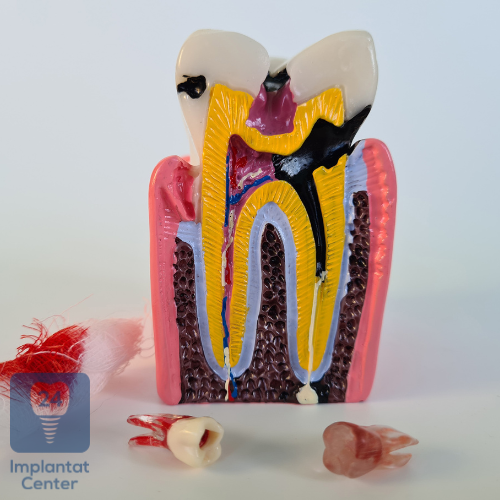 Gesundheitliche Schäden durch faule Zähne - Teil 1