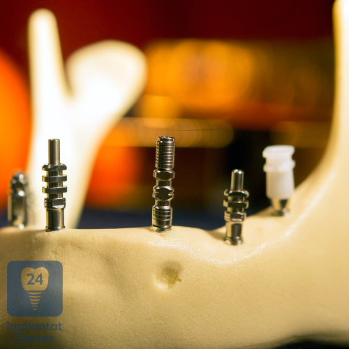 Knochentransplantation im Rahmen der Zahnimplantologie