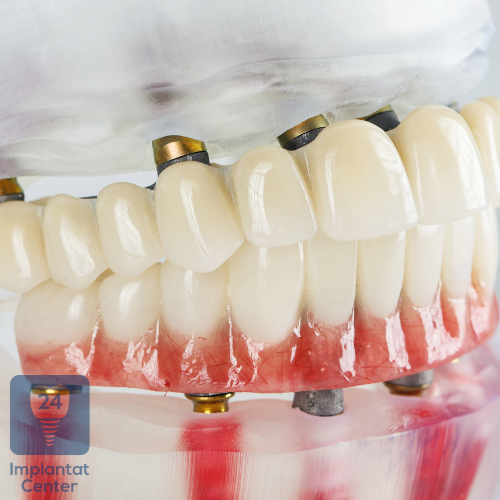 Zahnimplantate und Allergien