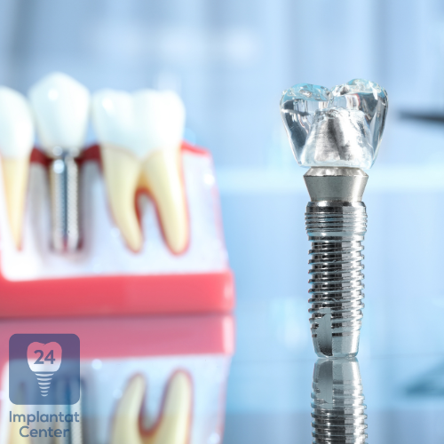 Einheilphase nach dem Einsetzen des Zahnimplantats