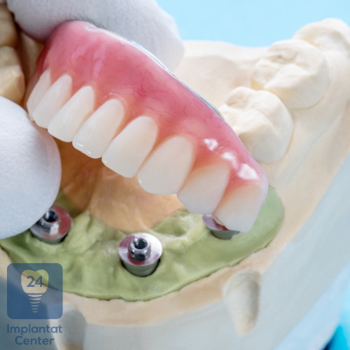 Definition und Grundprinzip des Zahnimplantats