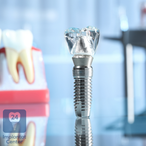 Arten von Zahnimplantaten