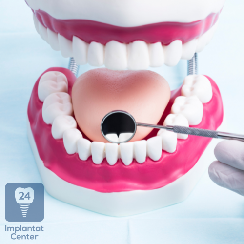 Tipps zur Vermeidung von Implantat Komplikationen