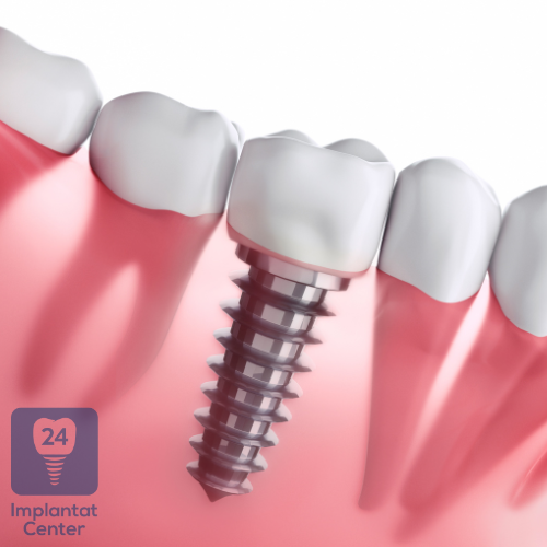 Funktionsweise und Osseointegration von Zahnimplantaten