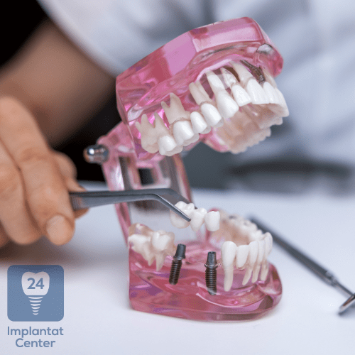 Vergleich der Kosten mit anderen Zahnersatzoptionen