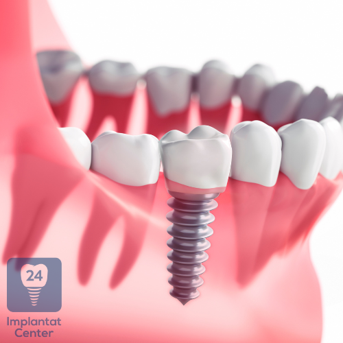 Funktionsweise und Osseointegration von Zahnimplantaten