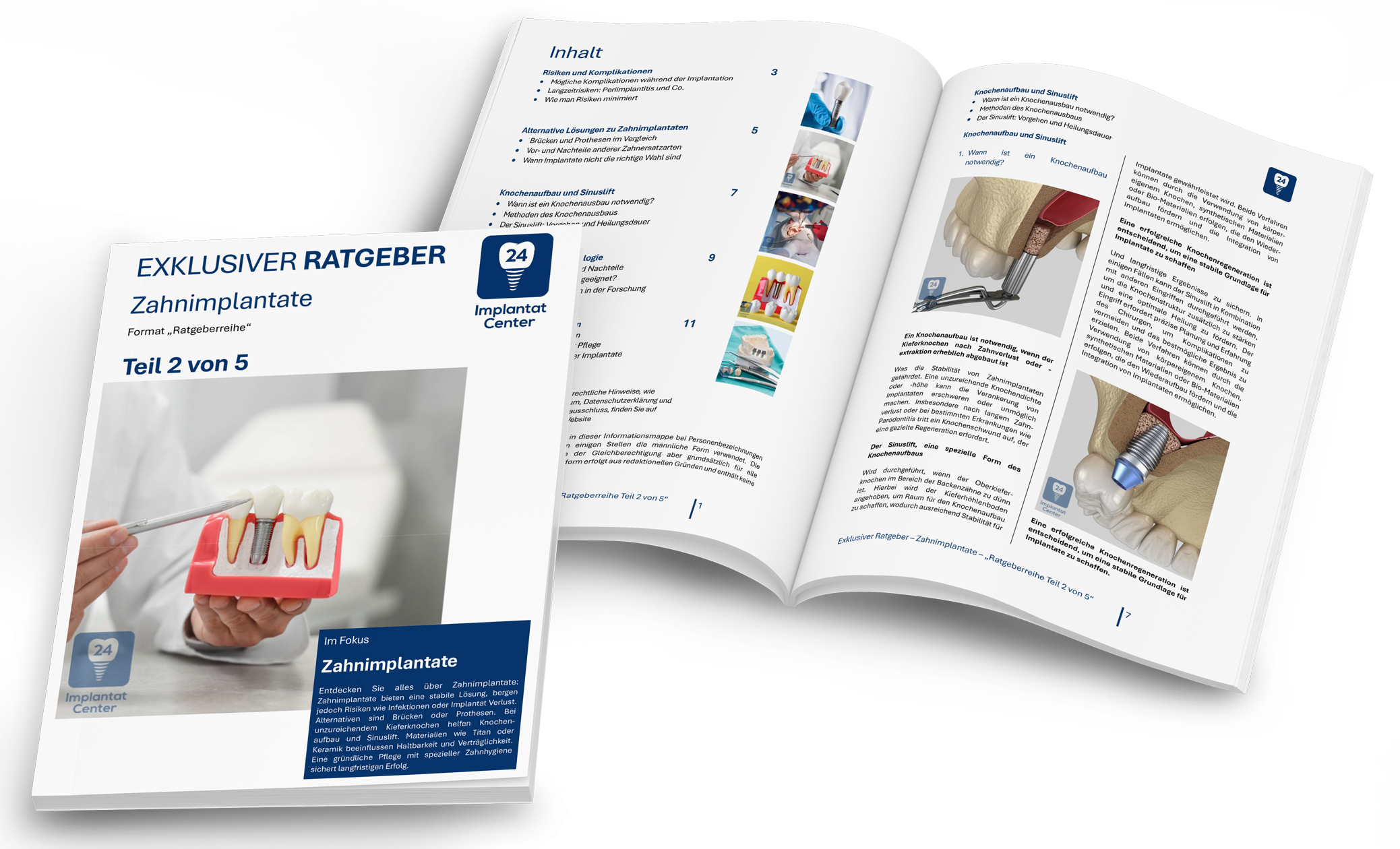 Broschüre und offenes Buch über Zahnimplantate mit Bildern von Zahnimplantat-Modellen, chirurgischen Verfahren und Illustrationen der Kieferanatomie.
