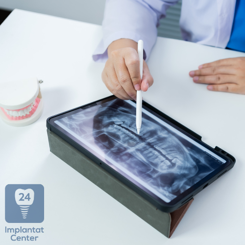 Vorbereitung auf die Zahnimplantation