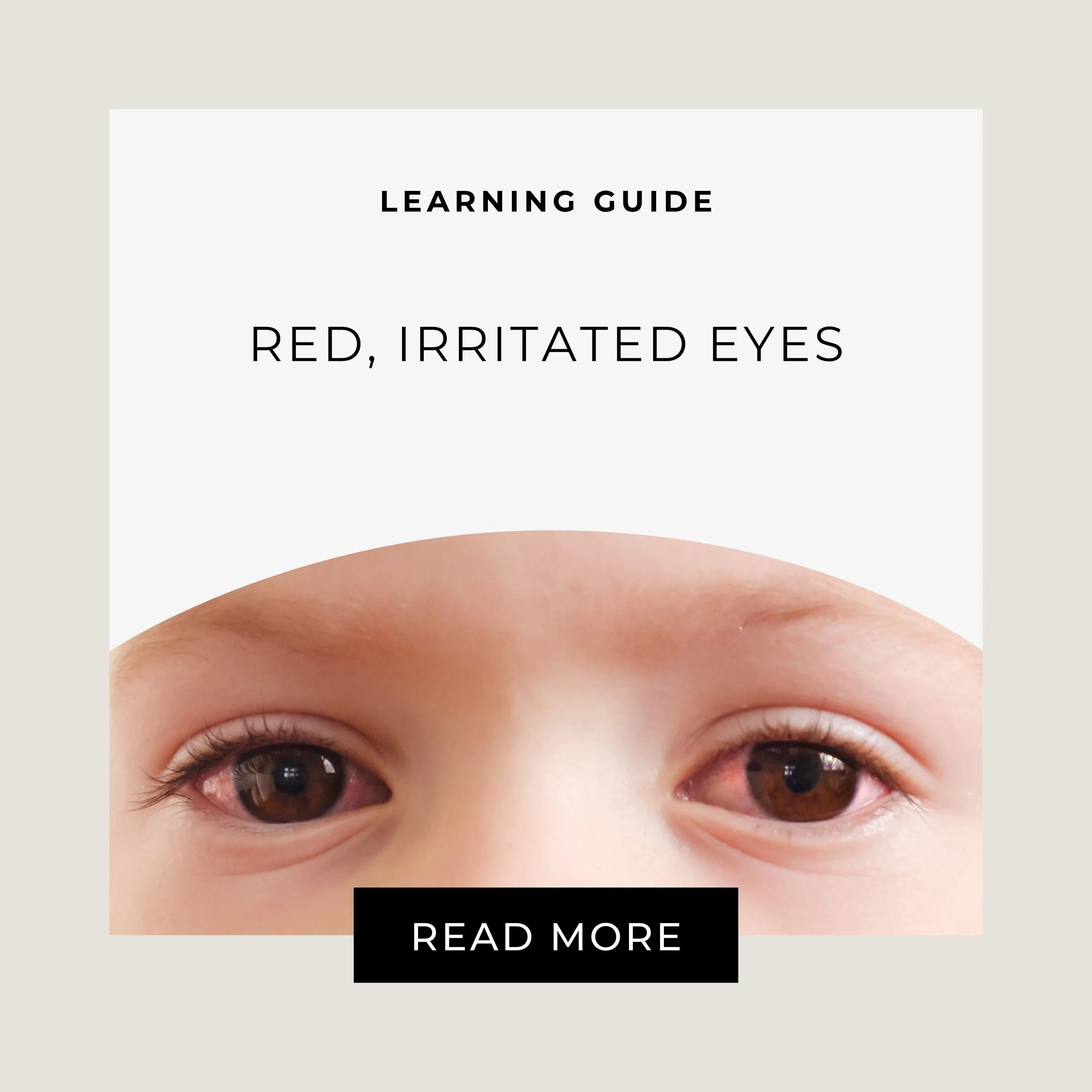 Homeopathy for Red, Irritated Eyes