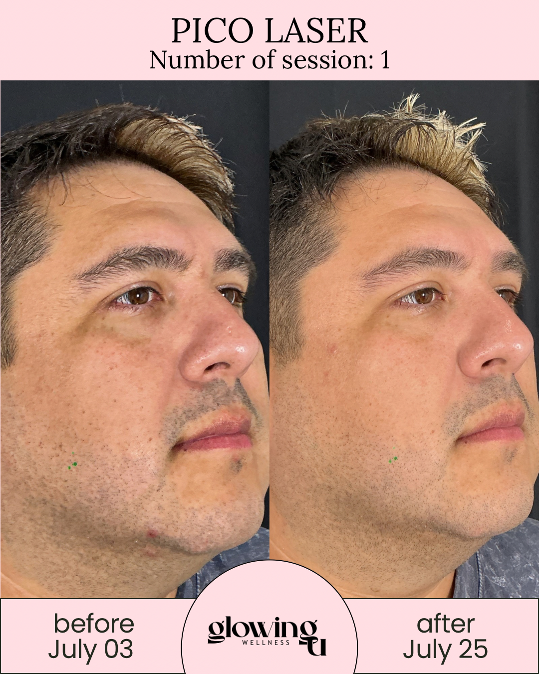 Side-by-side comparison of a man's face showing the results of Pico Laser treatment, with text indicating 'before July 03' and 'after July 25', and branding for Glowing Wellness.