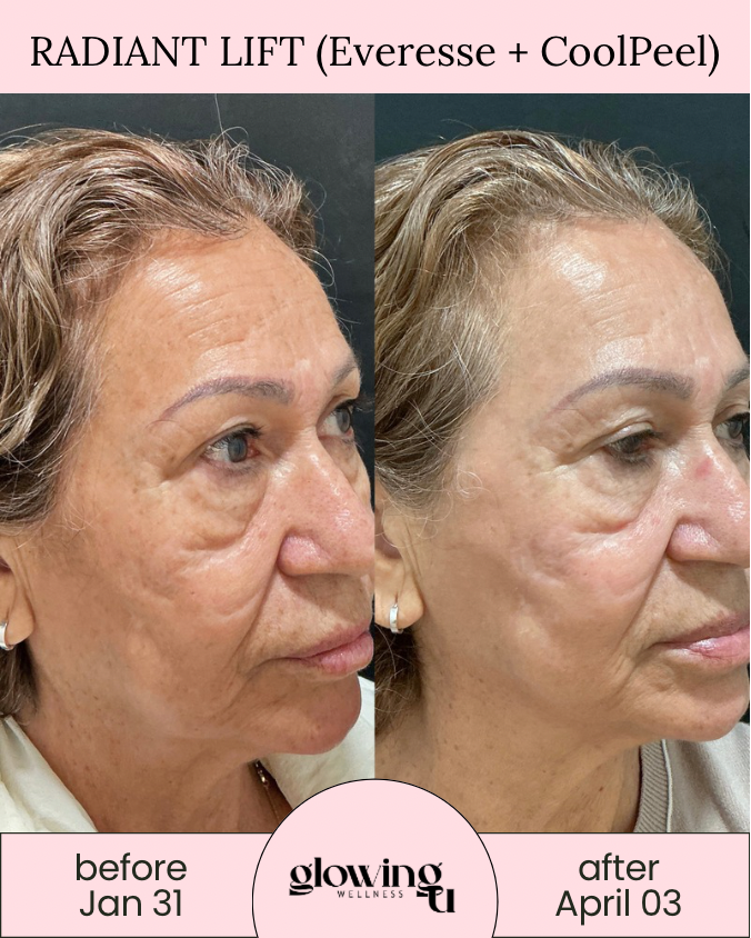 Side-by-side comparison of a woman’s face before and after a skincare treatment called Radiant Lift (Everesse + CoolPeel). The before picture is dated January 31, and the after picture is dated April 3. The woman's skin appears smoother and more rejuvenated in the after photo.