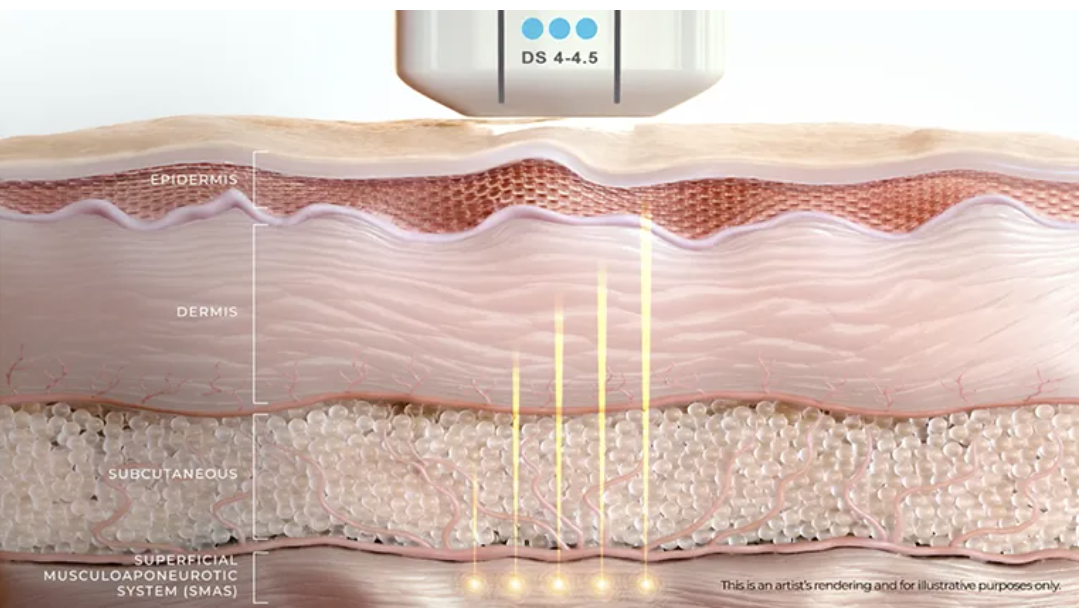 Cross-section of skin with laser treatment indicated, showing epidermis, dermis, subcutaneous tissue, and superficial musculoaponeurotic system (SMAS).