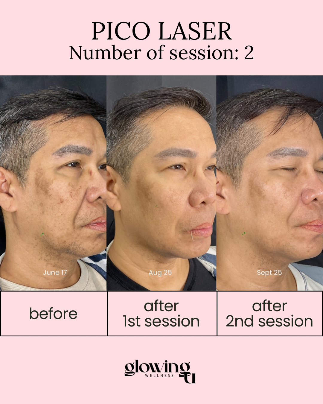 Before and after photos of a man showing skin improvement through Pico Laser treatment, with timestamps June 17, August 25, and September 25, and text indicating second session results.