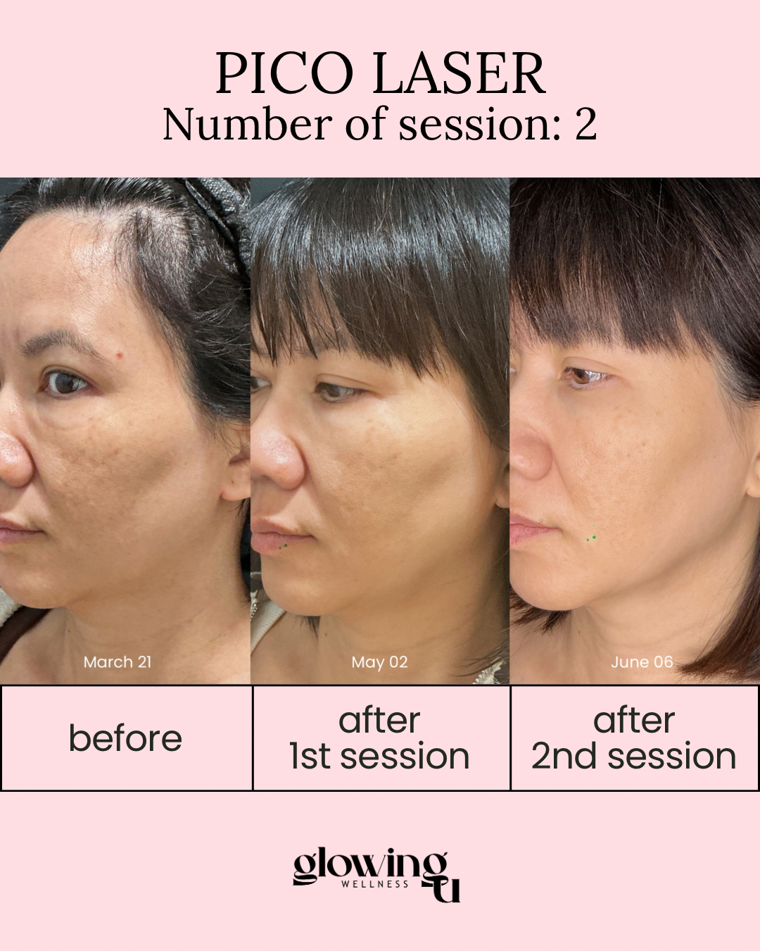 Progress photos of a woman's face showing skin improvements over time from March 21 to June 6, with labels indicating before, after first laser session, and after second laser session, from a skincare treatment at Glowing Wellness.