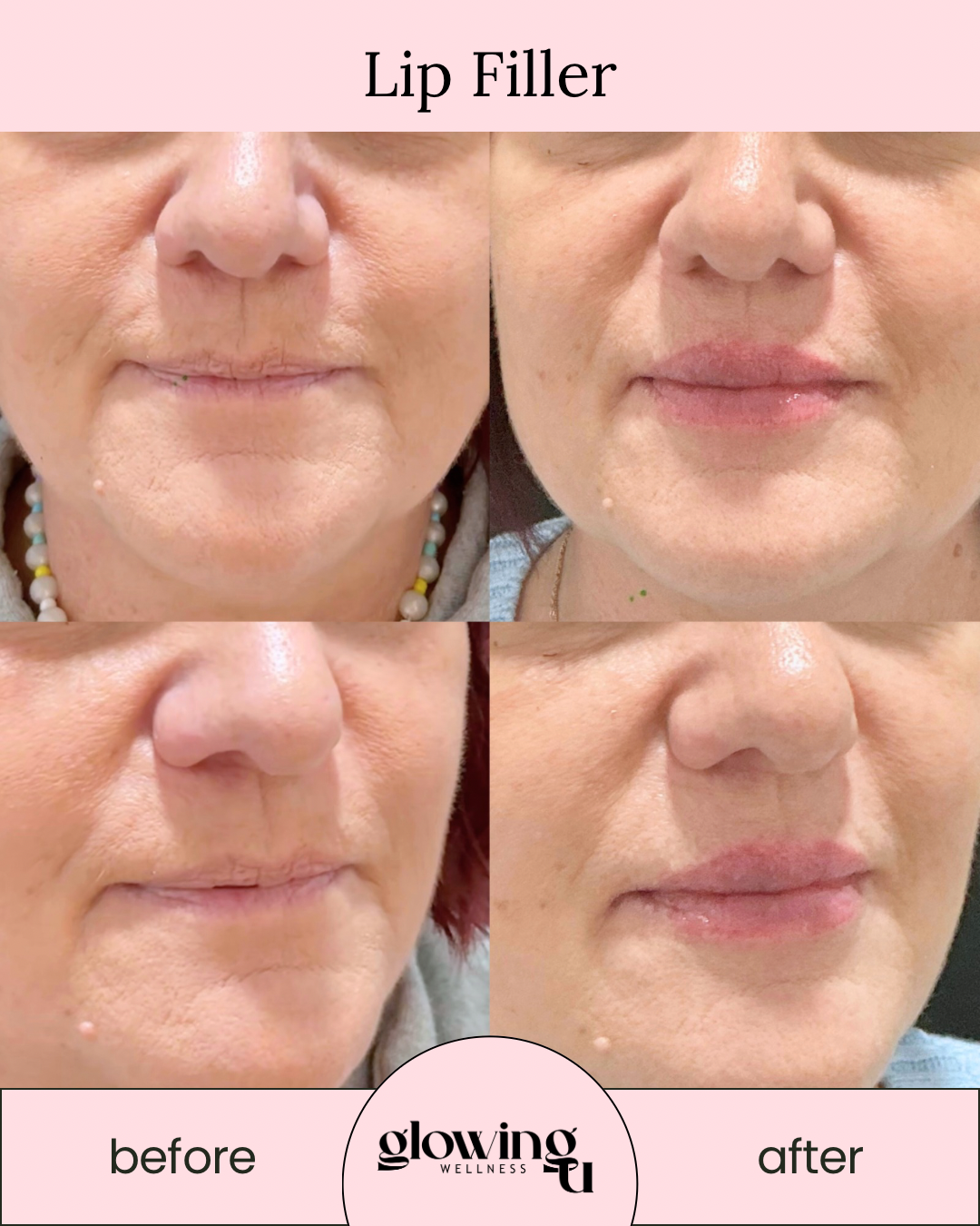Comparison of a woman's lips before and after using lip filler, showing fuller lips after treatment, with branding for Glowing Wellness
