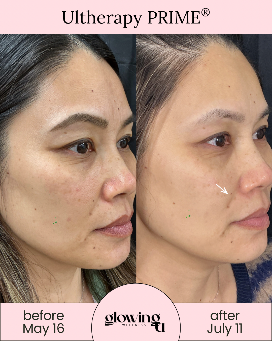 Side-by-side comparison of a woman's face showing skin improvement before May 16 and after July 11 following Ultherapy PRIME treatment, with the logo of Glowing Wellness.