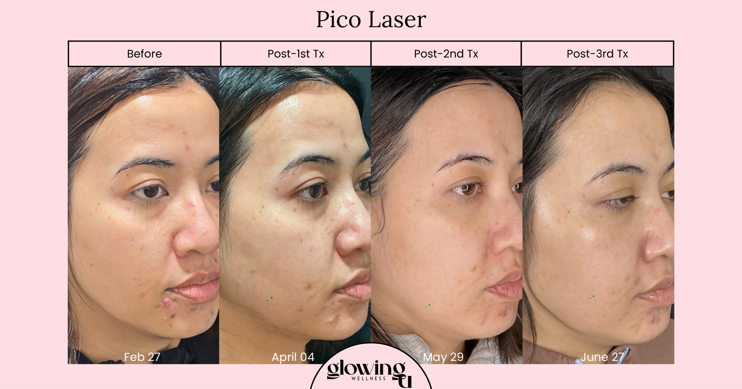 Progress photos of a woman's facial skin improvement over time, labeled with dates Feb 27, April 04, May 29, and June 27, indicating treatments for skin issues like acne and spots. The background is pink with a black table header titled 'Pico Laser' and a logo reading 'glowingo wellness'.
