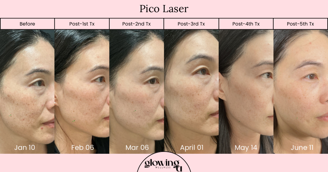 Series of six side-profile photos showing skin improvement after Pico Laser treatment, labeled from 'Before' to 'Post-5th Tx' with dates from January to June, illustrating reduction in hyperpigmentation.