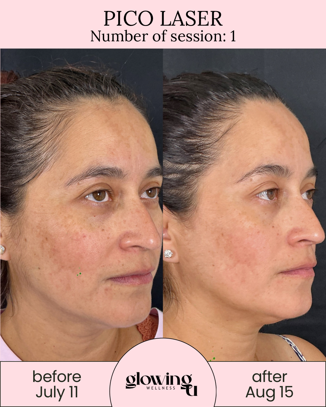 Side-by-side comparison of a woman's face before and after Pico Laser treatment, showing reduced pigmentation and improved skin tone, with the 'before' image dated July 11 and the 'after' image dated August 15, from Glowing Wellness.