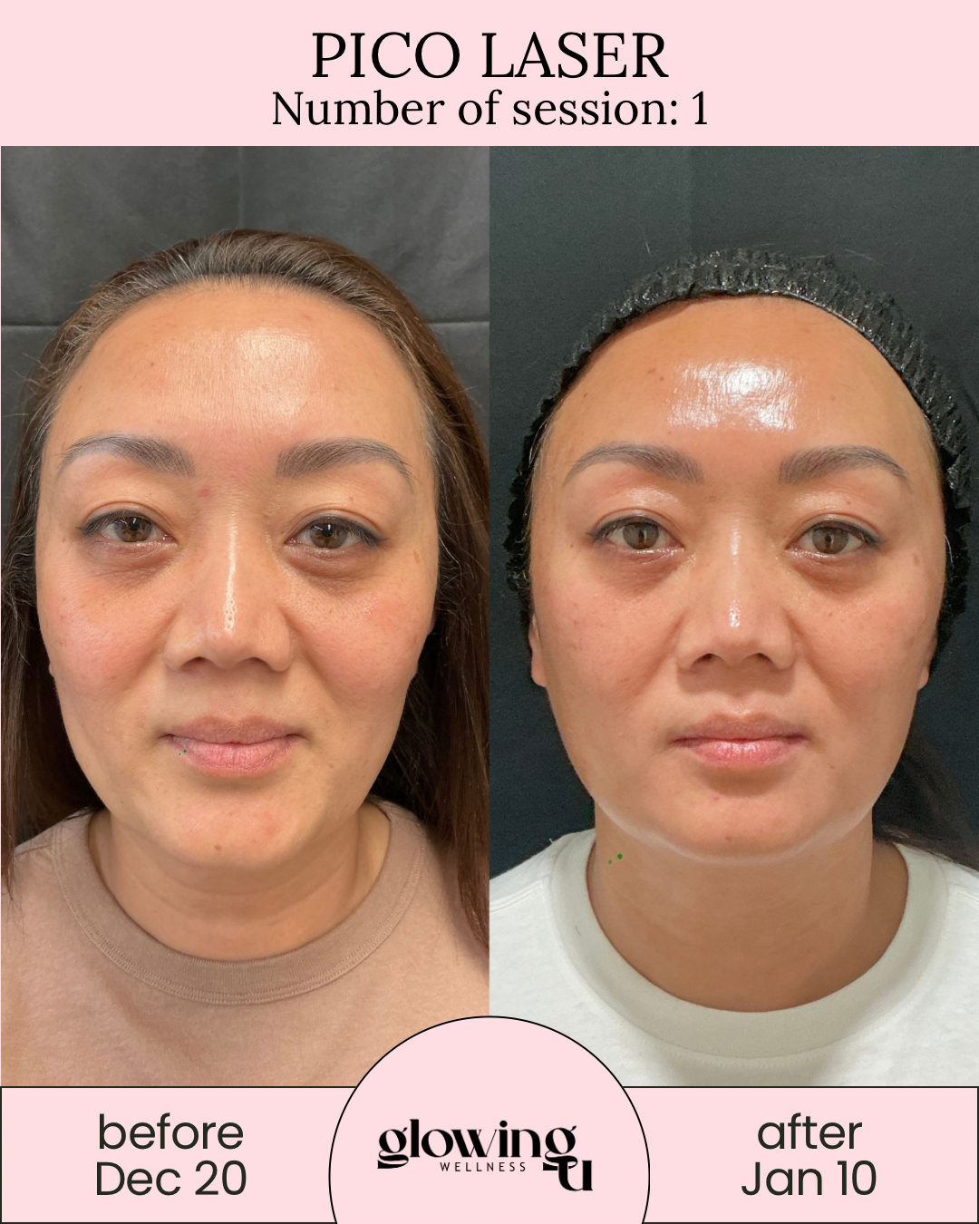 Side-by-side comparison of a woman's face before and after Pico Laser treatment. The left photo shows her skin before treatment on December 20, with visible pigmentation and uneven skin tone. The right photo shows her after treatment on January 10, with clearer, more even-toned skin. The top of the image has a pink background with text 'Pico Laser' and 'Number of session: 1'. The bottom has a pink banner with the logo 'glowing wellness' and the dates 'before Dec 20' and 'after Jan 10'.