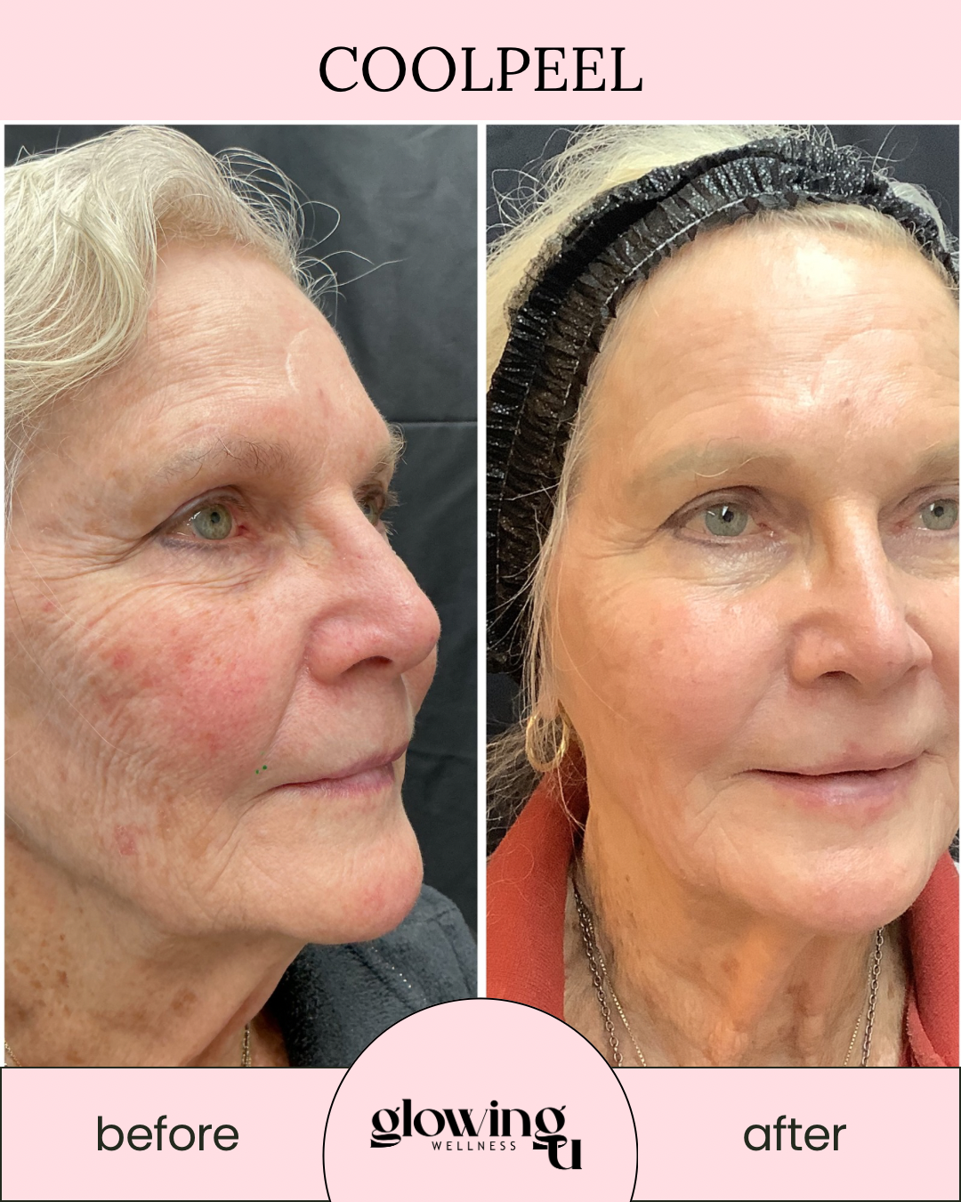 Side-by-side comparison of an older woman's face showing skin improvements before and after skincare treatment at CoolPeel, with the before image on the left and the after image on the right.