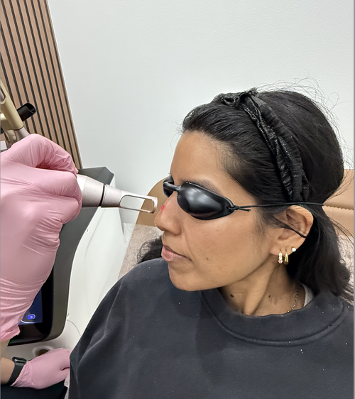 Laser Facial Treatment