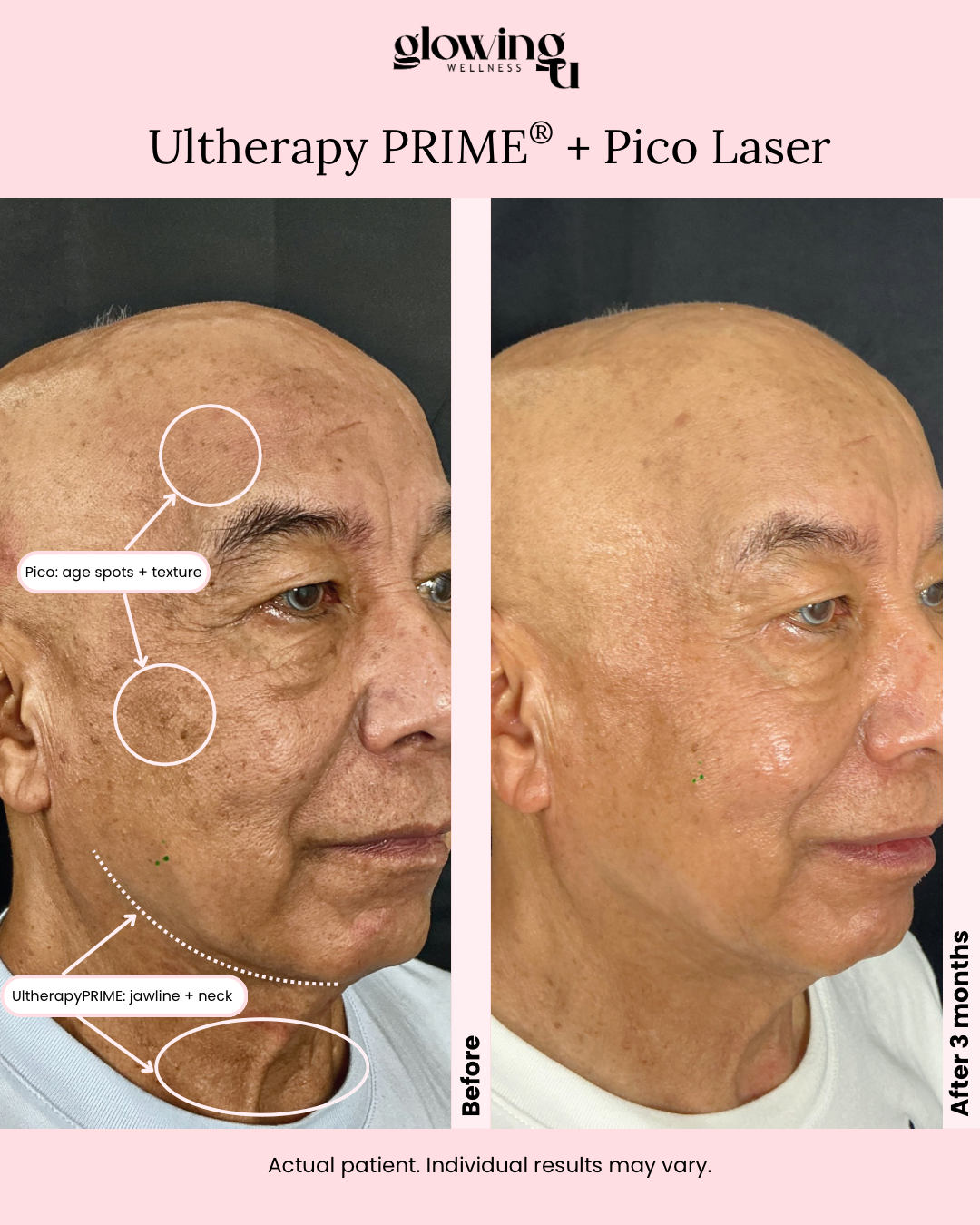 Ultherapy + Pico: A Natural, Youthful Refresh for Him