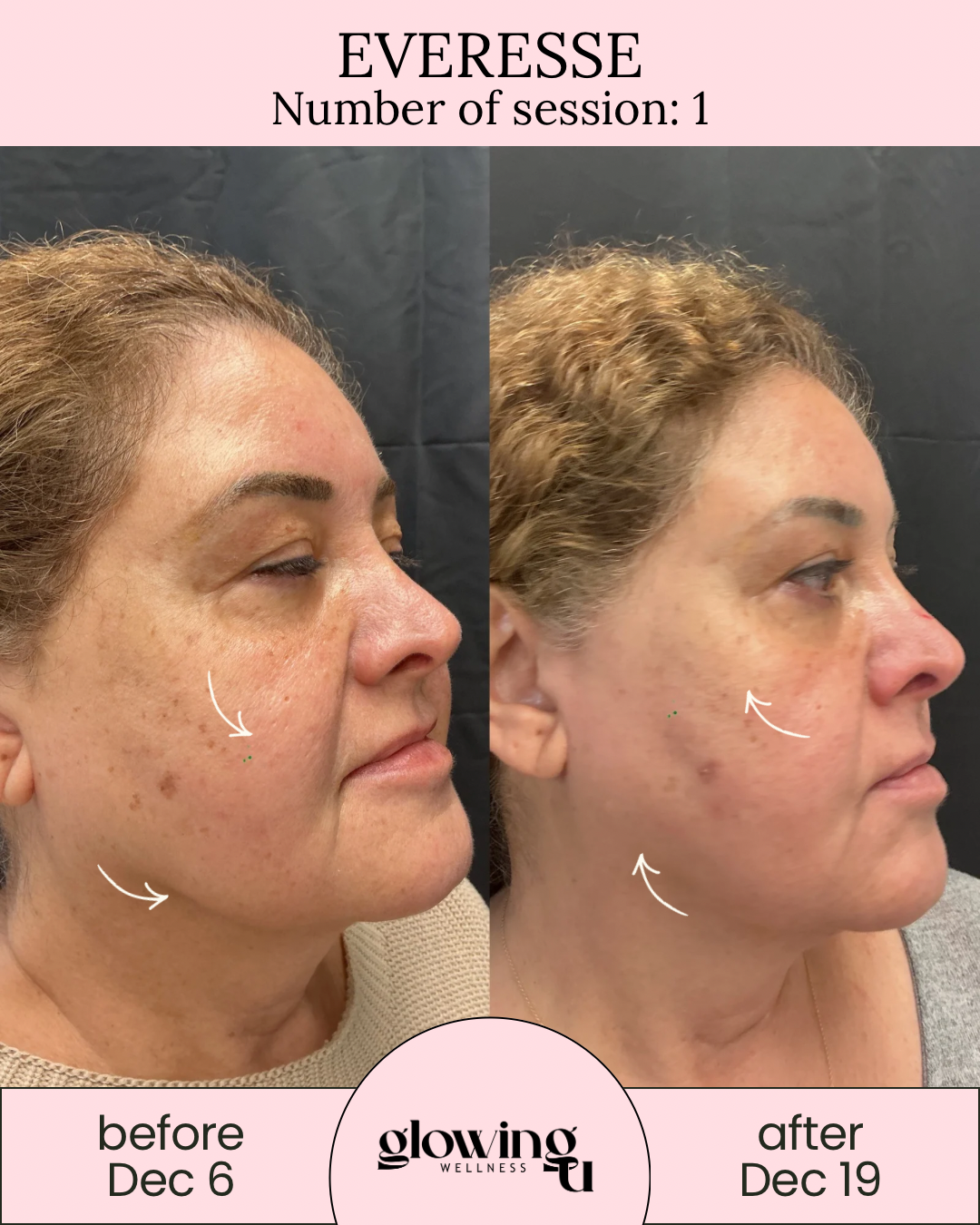 Side-by-side comparison of a woman's face before and after skin treatment, showing improvements in skin texture and pigmentation. The left photo is labeled 'before Dec 6' and the right photo is labeled 'after Dec 19'. from Glowing U Wellness