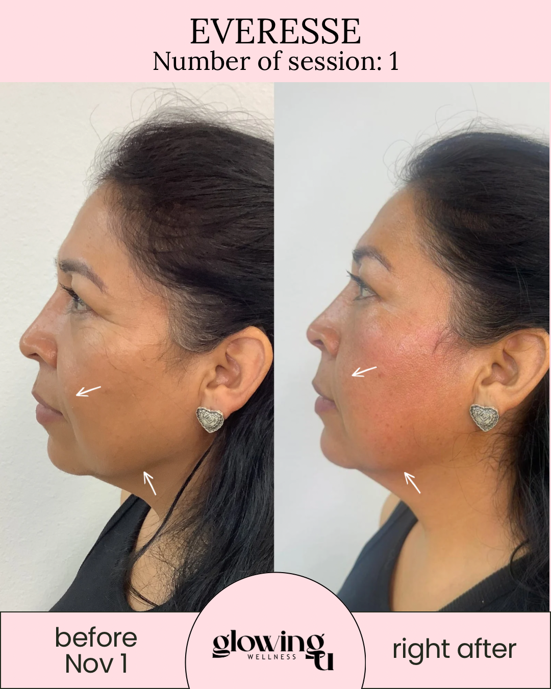 Side-by-side comparison of a woman's profile before and after a skincare treatment, showing improvements in skin texture and glow, with arrows pointing to specific facial areas. from Glowing U Wellness