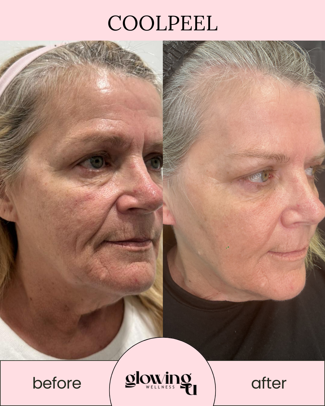 Side-by-side comparison of a woman's face before and after skincare treatment, showing improved skin texture and appearance. The left image is labeled "before" and the right image "after." from Glowing U Wellness