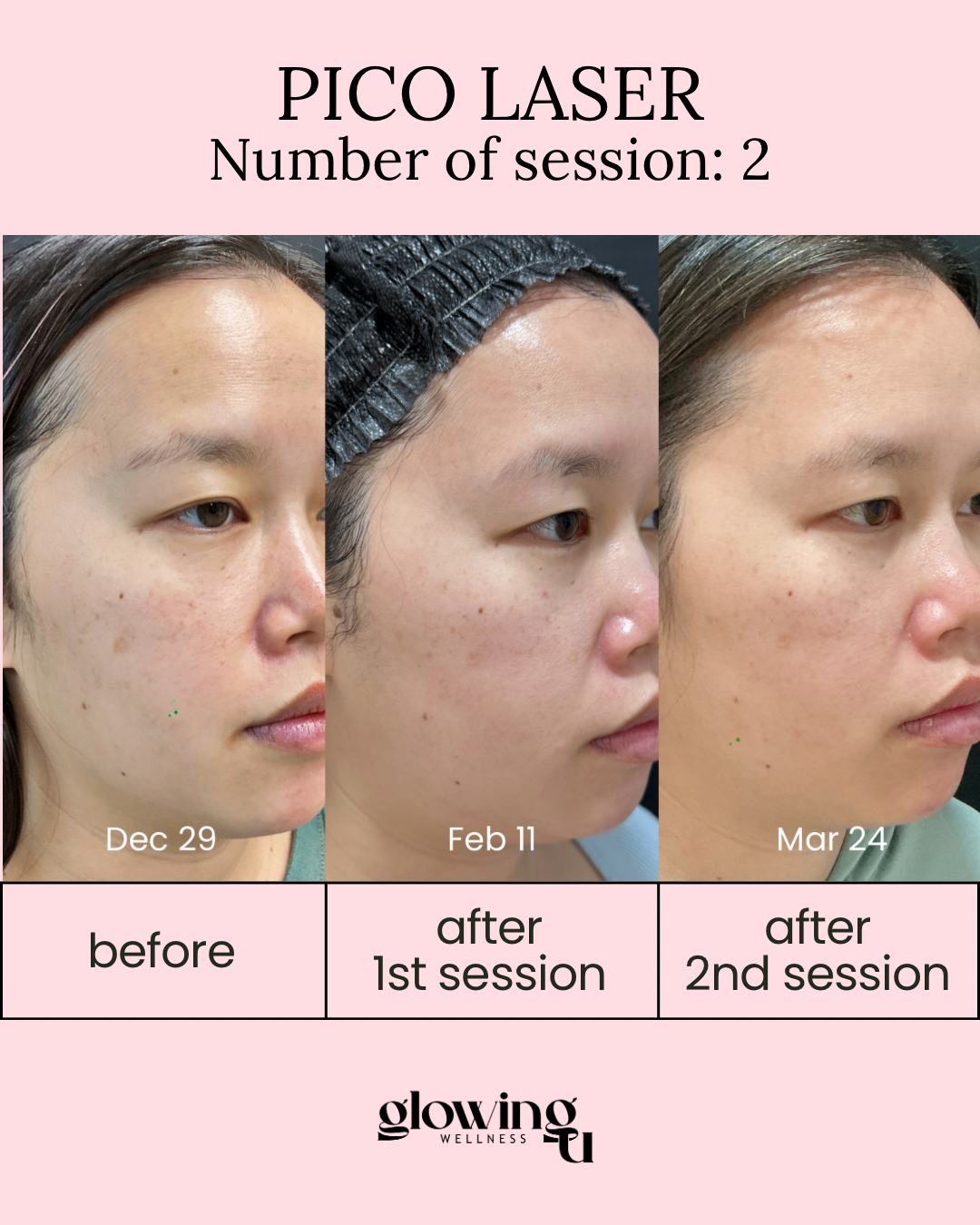 Timeline of a woman's facial skin improvement over three months due to Pico Laser treatment, showing photos from December 29, February 11, and March 24, labeled as before, after first session, and after second session.