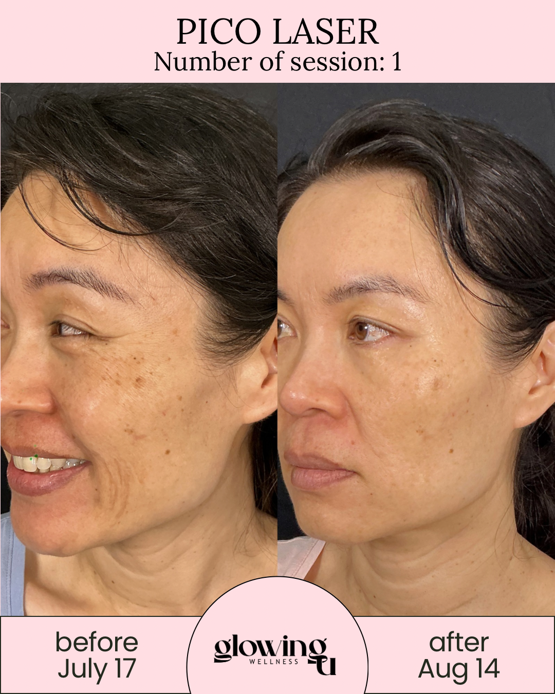 Side-by-side comparison of a woman's face showing skin improvement after Pico Laser treatment, with dates July 17 and August 14, and branding for Glowing Wellness.