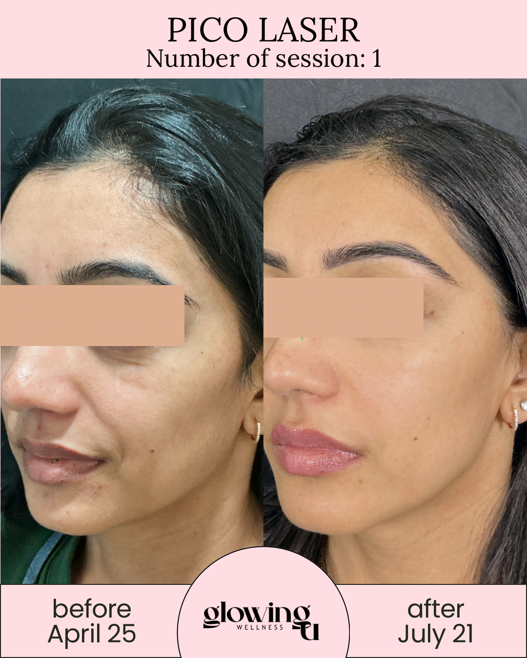 Side-by-side comparison of a woman's face before and after Pico Laser treatment, showing improved skin texture and tone. The before photo is dated April 25, and the after photo is dated July 21, with a pink background and text indicating the treatment details.