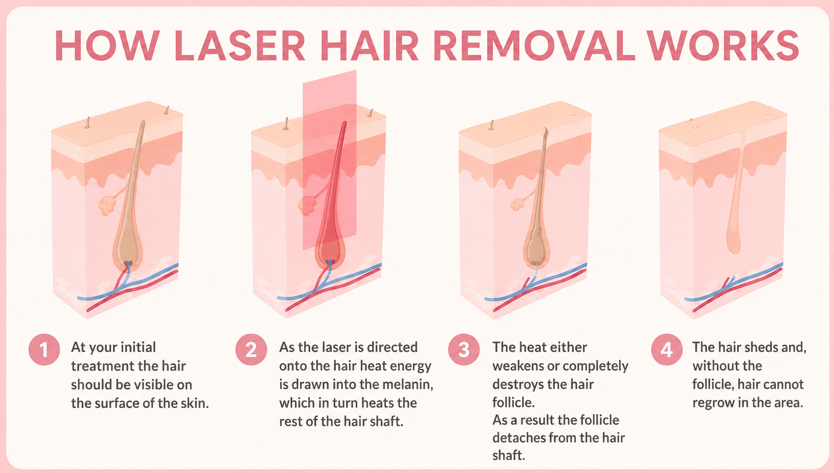 Laser hair removal results Torrance CA