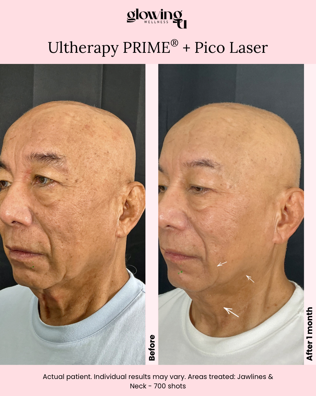 Side-by-side before and after photos of an older man showing skin improvement after Ultherapy PRIME and Pico Laser treatments, with noticeable reduction in wrinkles and sagging on his jawline and neck, eight weeks post-treatment, on a black background.