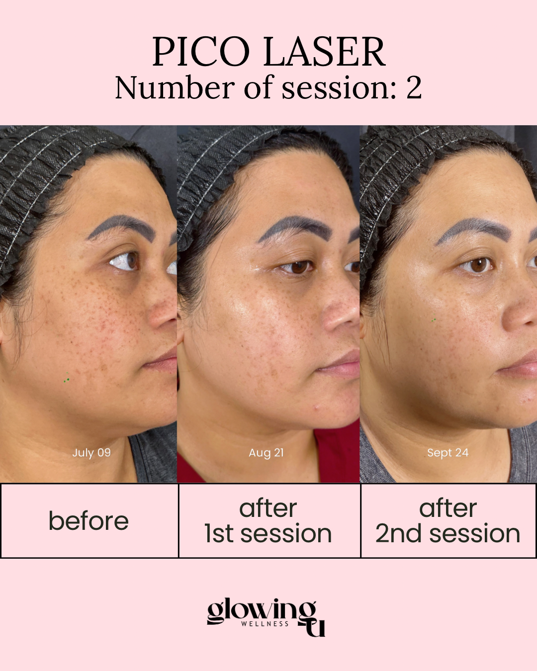 A photo sequence showing the progression of a woman's facial skin condition before and after Pico Laser treatments. The first image, labeled July 09, shows her skin before treatment with visible freckles and pigmentation. The second image, labeled August 21, shows her skin after the first session with reduced pigmentation. The third image, labeled September 24, shows further improvement with clearer skin. The text indicates this is for a Pico Laser session, with the second session being the second treatment. The images are from Glowing Wellness, demonstrating skin improvement over time.